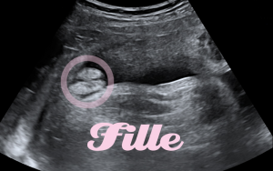 Échographie d'une fille - deuxième cliché légendé