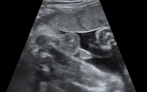 Échographie d'un garçon - premier cliché