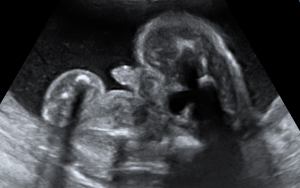 Échographie d'un garçon - deuxième cliché